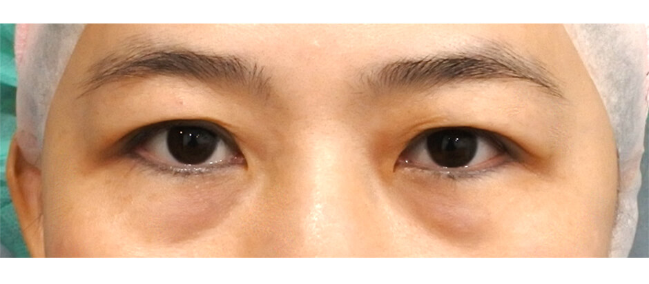 楊氏羅丹 醫學美容,眼袋淚溝,眼袋,黑眼圈,